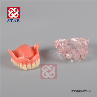 4個微型種植釘，上頜一尺修復。M6001